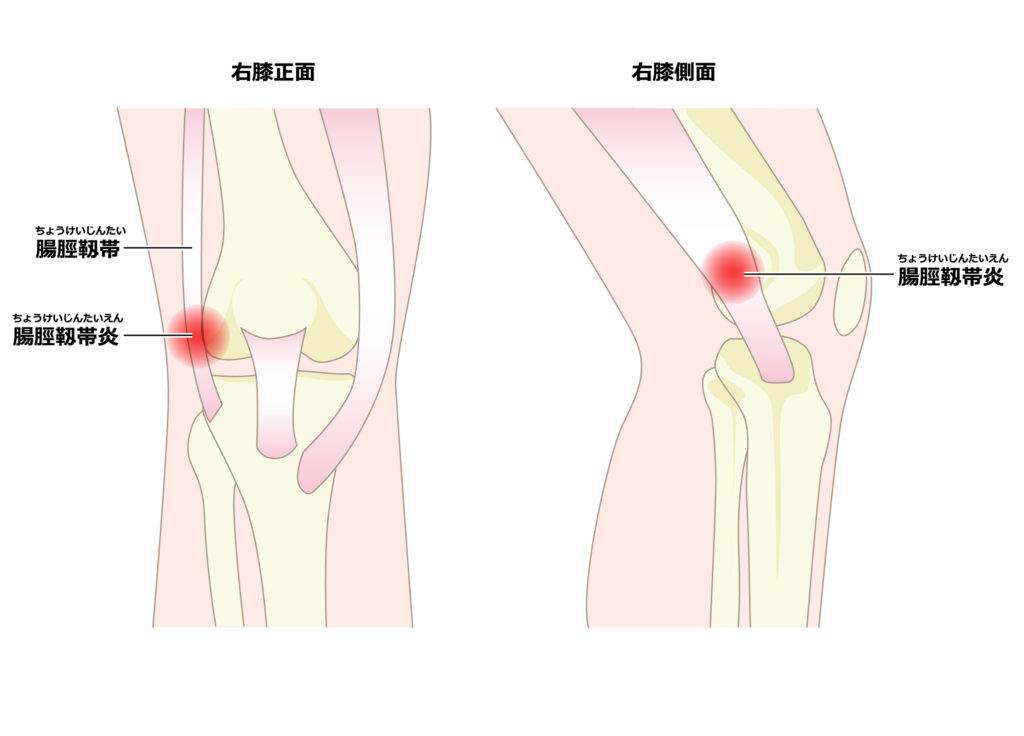 腸脛靭帯炎イラスト