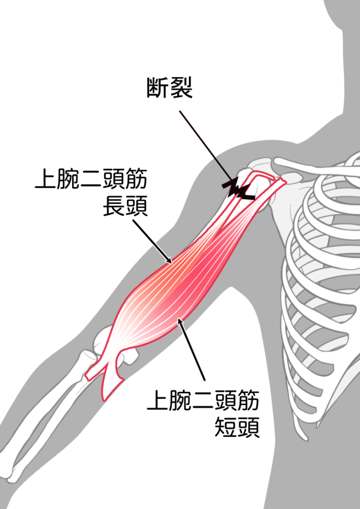 上腕二頭筋腱断裂イラスト