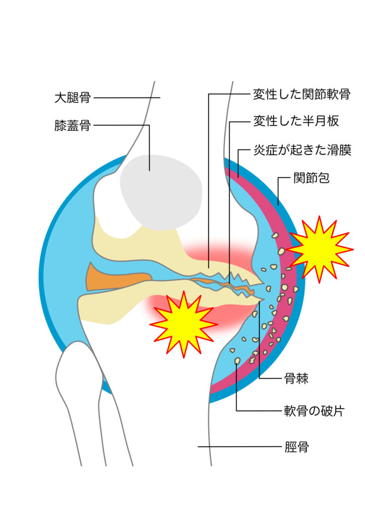 変形性膝関節症の説明イラスト