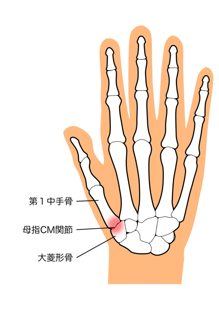 CM関節症説明イラスト