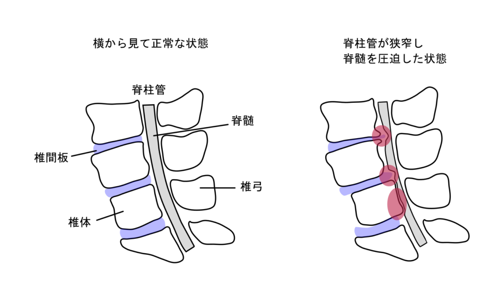 腰部脊柱管狭窄症のイラスト