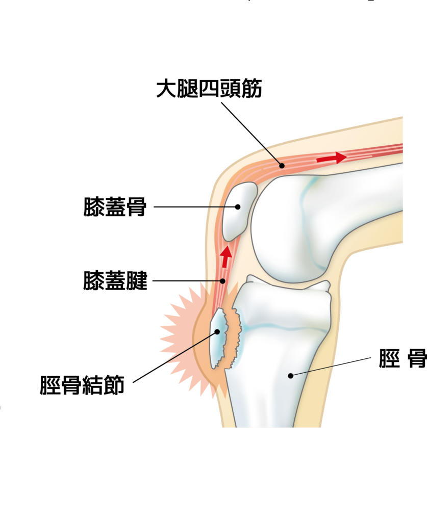 オスグッド・シュラッター病イラスト