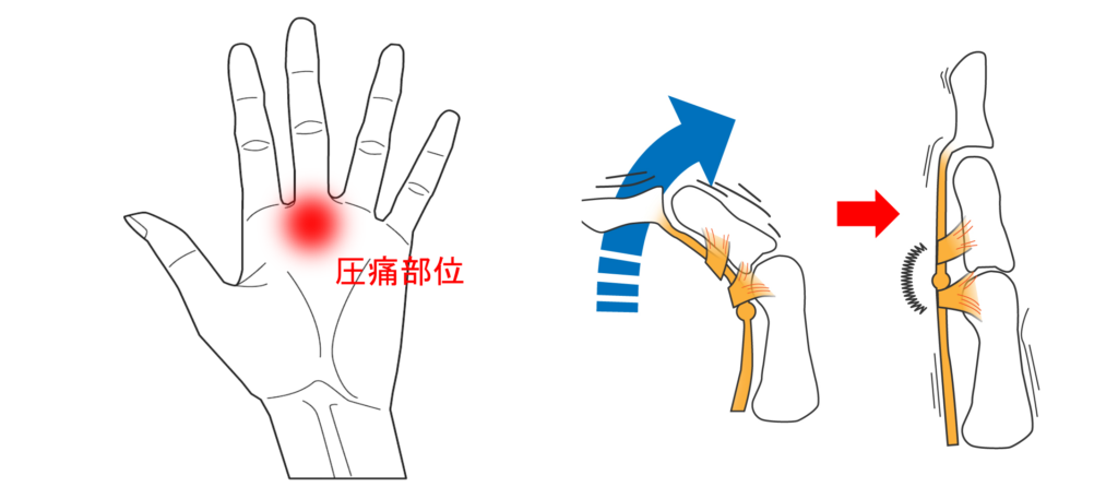 バネ指（弾発指）の説明図