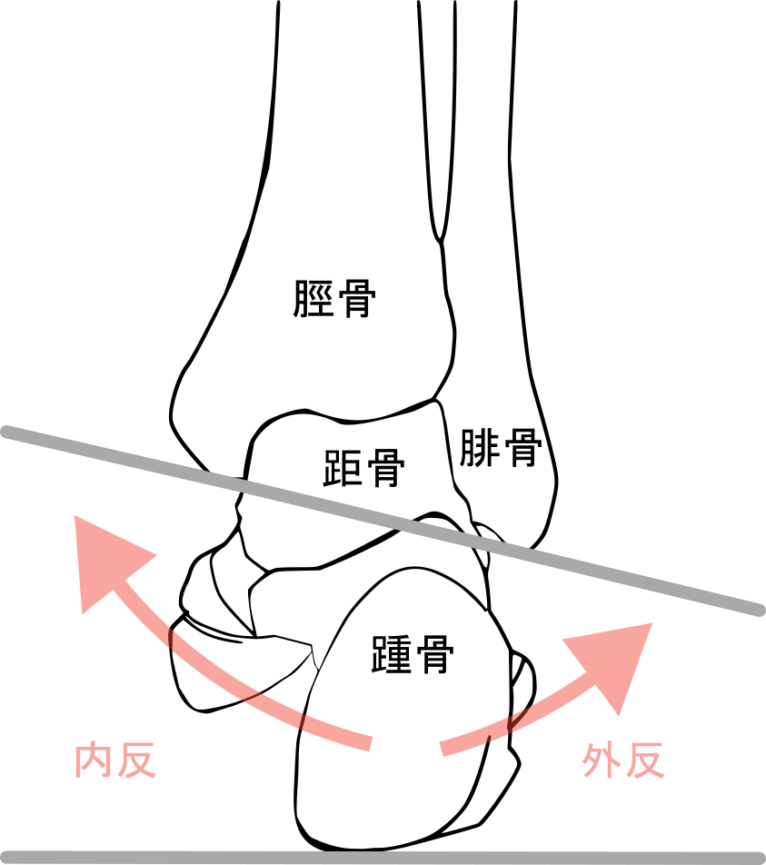 足関節捻挫のイラスト