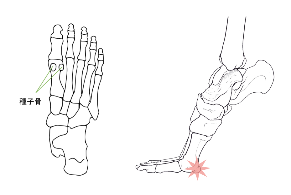 種子骨障害の説明イラスト