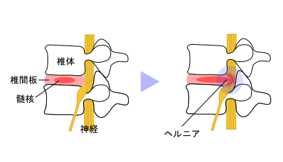 腰部椎間板ヘルニアの説明イラスト