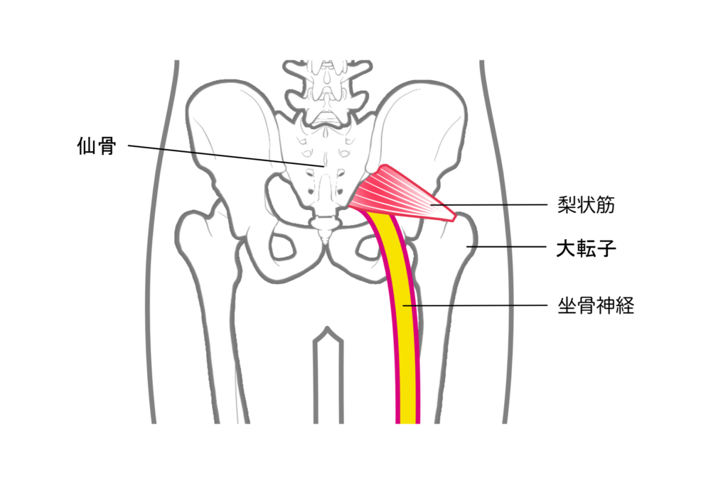 梨状筋症候群のイラスト