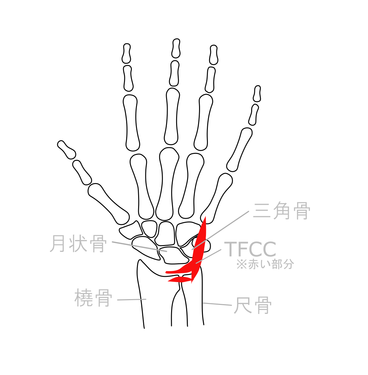 TFCC損傷イメージ