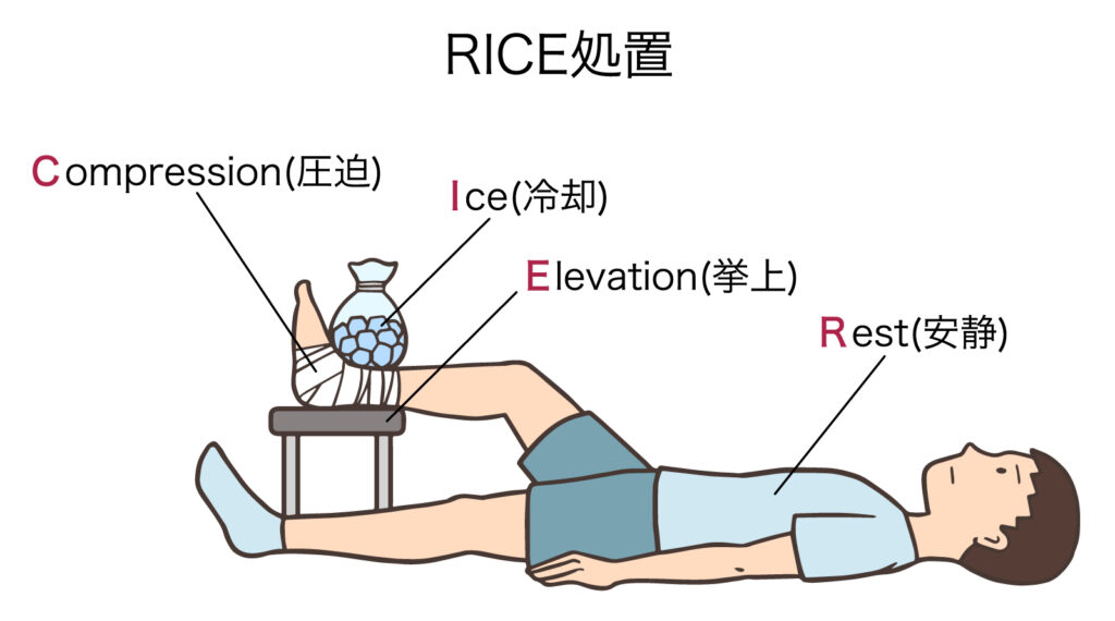 RICE処置の説明イラスト