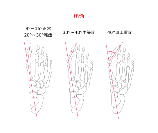 外反母趾角（HV角）の説明イラスト