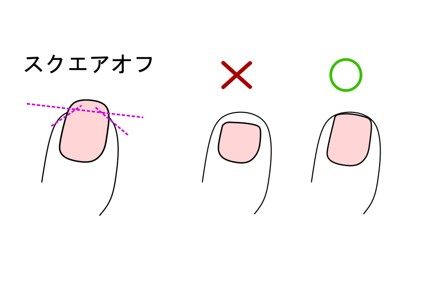 巻き爪陥入爪を予防するためのスクエアオフカットの説明
