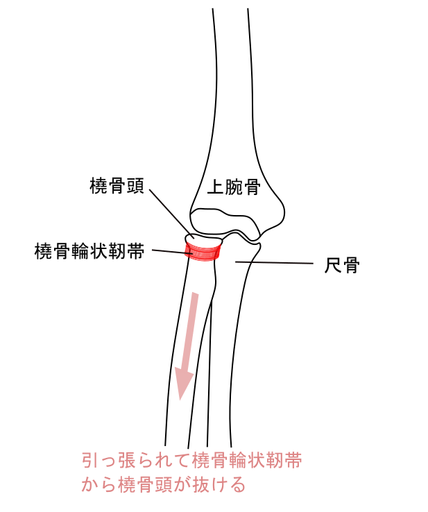 肘内障の説明イラスト