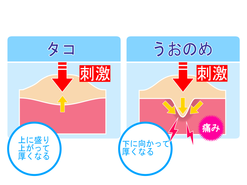 胼胝・鶏眼のイラスト